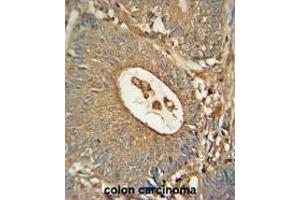 ACOX1 Monoclonal Antibody (ABIN659022 and ABIN2838046) immunohistochemistry analysis in formalin fixed and paraffin embedded human colon carcinoma followed by peroxidase conjμgation of the secondary antibody and DAB staining. (ACOX1 抗体)