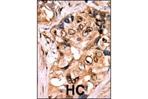 Formalin-fixed and paraffin-embedded human cancer tissue reacted with the primary antibody, which was peroxidase-conjugated to the secondary antibody, followed by AEC staining. (MEK1 抗体  (pSer218, pSer222))
