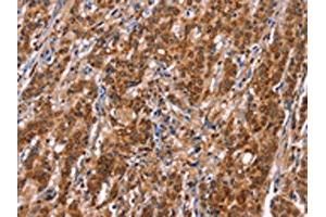 The image on the left is immunohistochemistry of paraffin-embedded Human gastic cancer tissue using ABIN7192753(TDP2 Antibody) at dilution 1/40, on the right is treated with synthetic peptide. (TDP2 抗体)