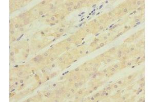 Immunohistochemistry of paraffin-embedded human gastric cancer using ABIN7143005 at dilution of 1:100 (ACCN5 抗体  (AA 140-330))