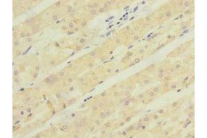 Immunohistochemistry of paraffin-embedded human gastric cancer using ABIN7143005 at dilution of 1:100 (ACCN5 抗体  (AA 140-330))