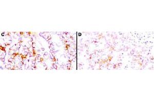 Immunohistochemistry (IHC) image for anti-Mesothelin (MSLN) (Extracellular Domain) antibody (ABIN400815) (Mesothelin 抗体  (Extracellular Domain))