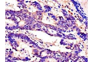 Immunohistochemistry of paraffin-embedded human colon cancer using ABIN7168925 at dilution of 1:100 (SPINK1 抗体  (AA 19-79))