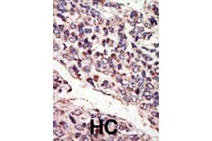 Formalin-fixed and paraffin-embedded human cancer tissue reacted with the primary antibody, which was peroxidase-conjugated to the secondary antibody, followed by DAB staining.