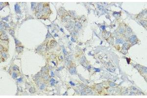 Immunohistochemistry of paraffin-embedded Human mammary cancer using SOCS6 Polyclonal Antibody at dilution of 1:100 (40x lens). (SOCS6 抗体)