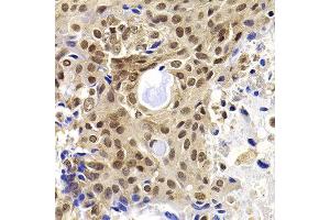 Immunohistochemistry of paraffin-embedded human oophoroma using PHF19 antibody at dilution of 1:100 (x40 lens). (PHF19 抗体)