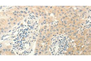 Immunohistochemistry of paraffin-embedded Human lung cancer using ERG Polyclonal Antibody at dilution of 1:40 (ERG 抗体)