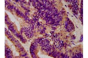 IHC image of ABIN7151667 diluted at 1:600 and staining in paraffin-embedded human colon cancer performed on a Leica BondTM system.