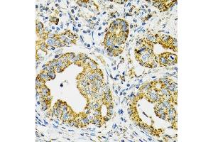 Immunohistochemistry of paraffin-embedded human gastric cancer using HSPA9 antibody. (HSPA9 抗体  (AA 380-679))