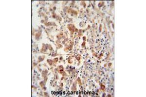 TEX13B antibody immunohistochemistry analysis in formalin fixed and paraffin embedded human testis carcinoma followed by peroxidase conjugation of the secondary antibody and DAB staining. (TEX13B 抗体  (C-Term))