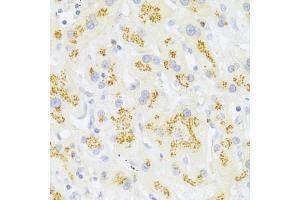 Immunohistochemistry of paraffin-embedded human liver cancer using FAS Antibody (ABIN5970062) at dilution of 1/100 (40x lens). (FAS 抗体)