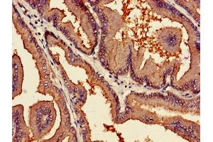 Immunohistochemistry of paraffin-embedded human prostate cancer using ABIN7163761 at dilution of 1:100 (PARN 抗体  (AA 1-639))