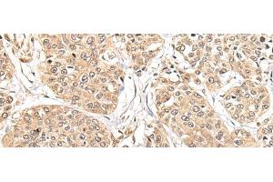 Immunohistochemistry of paraffin-embedded Human prost at e cancer tissue using ATL3 Polyclonal Antibody at dilution of 1:85(x200) (ATL3 抗体)