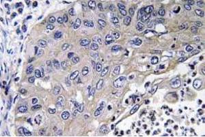 Immunohistochemistry (IHC) analyzes of Cathepsin D antibody in paraffin-embedded human lung carcinoma tissue. (Cathepsin D 抗体)