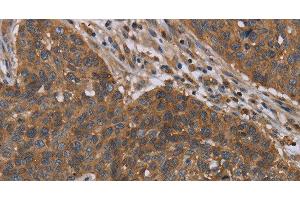 Immunohistochemistry of paraffin-embedded Human lung cancer tissue using OXTR Polyclonal Antibody at dilution 1:40 (Oxytocin Receptor 抗体)