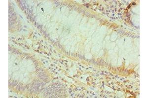 Immunohistochemistry of paraffin-embedded human colon cancer using ABIN7147161 at dilution of 1:100 (CD48 抗体  (AA 27-125))