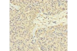 Immunohistochemistry of paraffin-embedded human ovarian cancer using ABIN7165526 at dilution of 1:100 (Protein FAM60A (SINHCAF) (AA 1-221) 抗体)