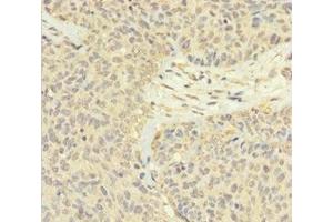 Immunohistochemistry of paraffin-embedded human ovarian cancer using ABIN7165526 at dilution of 1:100 (FAM60A 抗体  (AA 1-221))