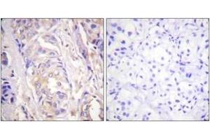 Immunohistochemistry analysis of paraffin-embedded human breast carcinoma tissue, using MEK1 (Ab-286) Antibody. (MEK1 抗体  (AA 252-301))