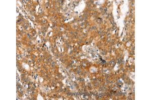 Immunohistochemistry of Human gastic cancer using MMP2 Polyclonal Antibody at dilution of 1:60 (MMP2 抗体)