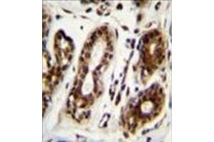 Formalin fixed, paraffin embedded human breast tissue stained with Nucleolin Antibody (Center) followed by peroxidase conjugation of the secondary antibody and DAB staining. (Nucleolin 抗体  (Middle Region))