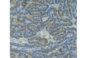 Used in DAB staining on fromalin fixed paraffin- embedded thyroid cancer tissue