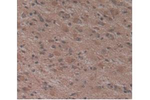 Detection of ATN1 in Human Glioma Tissue using Monoclonal Antibody to Atrophin 1 (ATN1) (Atrophin 1 抗体  (AA 879-1190))