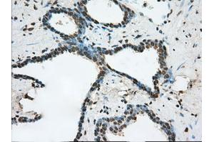 Immunohistochemical staining of paraffin-embedded prostate tissue using anti-ERCC1 mouse monoclonal antibody. (ERCC1 抗体)