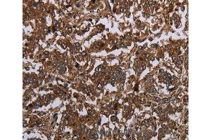 Immunohistochemistry of Human gastric cancer using HOMER2 Polyclonal Antibody at dilution of 1:30 (HOMER2 抗体)