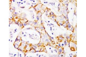 IHC-P: beta Catenin antibody testing of human breast cancer tissue (beta Catenin 抗体  (AA 764-781))