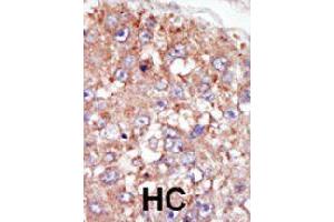 Formalin-fixed and paraffin-embedded human hepatocellular carcinoma tissue reacted with PTK6 polyclonal antibody  , which was peroxidase-conjugated to the secondary antibody, followed by AEC staining. (PTK6 抗体  (N-Term))