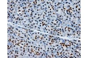 Immunohistochemical staining of paraffin-embedded Adenocarcinoma of colon tissue using anti-RC204952 mouse monoclonal antibody. (XRCC1 抗体)