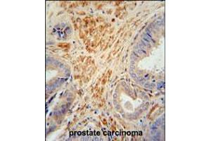 FSTL1 antibody immunohistochemistry analysis in formalin fixed and paraffin embedded human prostate carcinoma followed by peroxidase conjugation of the secondary antibody and DAB staining. (FSTL1 抗体  (C-Term))