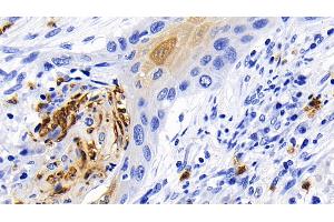 Detection of CASP1 in Human Lung cancer Tissue using Polyclonal Antibody to Caspase 1 (CASP1) (Caspase 1 抗体  (AA 120-297))