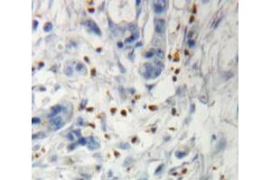 IHC-P analysis of pancreas tissue, with DAB staining. (IGF2BP3 抗体  (AA 2-343))