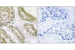 Immunohistochemistry analysis of paraffin-embedded human lung carcinoma tissue, using BAX Antibody. (BAX 抗体  (AA 80-129))