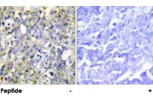 Immunohistochemical analysis of paraffin-embedded human lung carcinoma tissue using IGFBP3 polyclonal antibody . (IGFBP3 抗体  (Ser183))