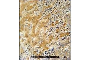 NUS antibody (N-term) 11000a immunohistochemistry analysis in formalin fixed and paraffin embedded human hepatocarcinoma followed by peroxidase conjugation of the secondary antibody and DAB staining. (NUSAP1 抗体  (N-Term))