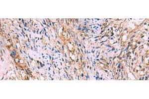Immunohistochemistry of paraffin-embedded Human cervical cancer tissue using GALK2 Polyclonal Antibody at dilution of 1:95(x200) (GALK2 抗体)