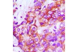 Immunohistochemical analysis of ZP1 staining in human breast cancer formalin fixed paraffin embedded tissue section. (ZP1 抗体)