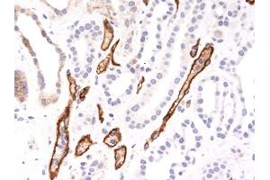 Formalin-fixed, paraffin-embedded human Hepatocellular Carcinoma stained with Complement 4d Mouse Monoclonal Antibody (C4D204).