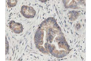 Immunohistochemical staining of paraffin-embedded Adenocarcinoma of Human colon tissue using anti-LGR5 mouse monoclonal antibody. (LGR5 抗体  (AA 250-550))
