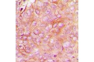 Immunohistochemical analysis of STMN1 (pS16) staining in human breast cancer formalin fixed paraffin embedded tissue section. (Stathmin 1 抗体  (N-Term, pSer16))
