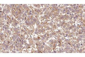 ABIN6279695 at 1/100 staining Human Melanoma tissue by IHC-P. (S100A7 抗体  (C-Term))