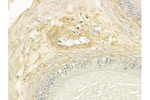 ABIN6260013 and ABIN6279138 at 1/100 staining human testicular cancer by IHC-P. (Aquaporin 8 抗体  (N-Term))