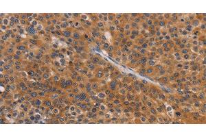 Immunohistochemistry of paraffin-embedded Human liver cancer tissue using NCR1 Polyclonal Antibody at dilution 1:30 (NCR1 抗体)