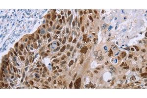 Immunohistochemistry of paraffin-embedded Human esophagus cancer using MAGEA10 Polyclonal Antibody at dilution of 1:50 (MAGEA10 抗体)