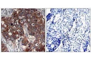 Immunohistochemical analysis of paraffin- embedded human breast carcinoma tissue using HER2 (Ab-877) antibody (E021070). (ErbB2/Her2 抗体)