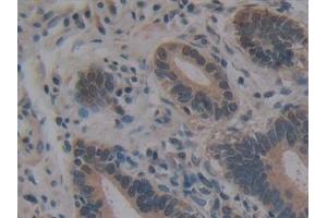 Detection of VIL in Human Stomach cancer Tissue using Polyclonal Antibody to Villin (VIL)