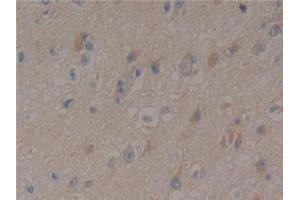 Detection of PXN in Human Glioma Tissue using Polyclonal Antibody to Paxillin (PXN) (Paxillin 抗体  (AA 201-461))